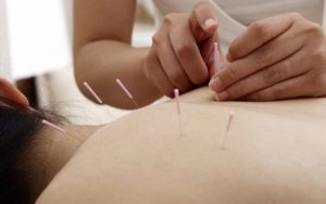 castlemore acupuncture