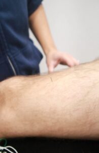 acupuncture